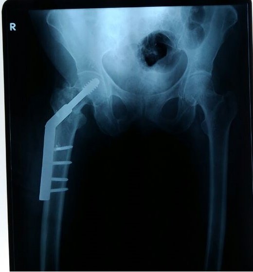 Dynamic Hip Screw implant X-ray