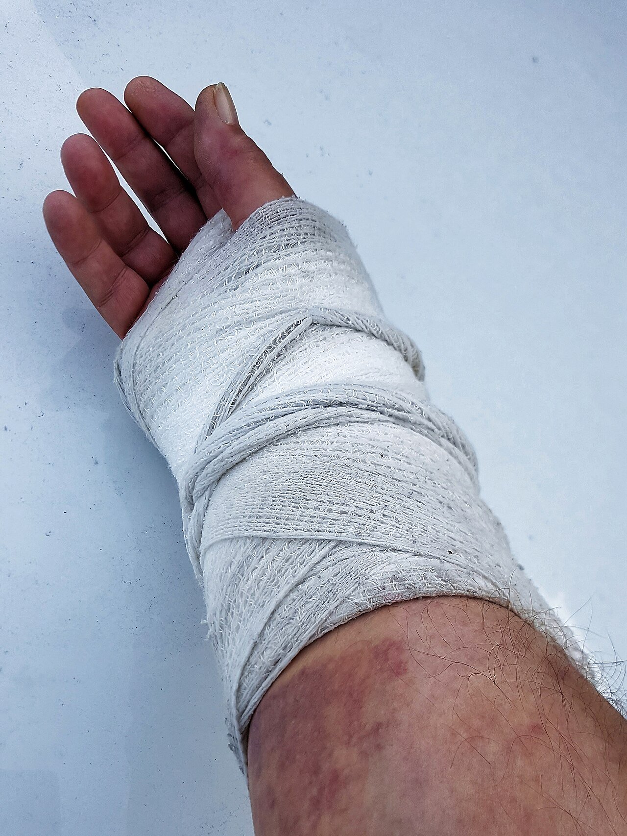 Orthopedic plaster cast